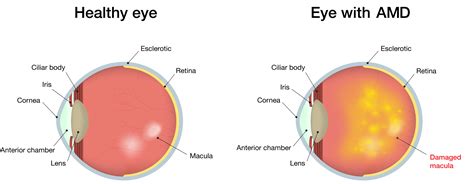 amd eye disease